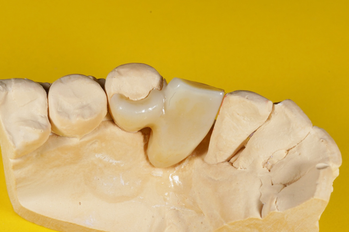 出来るだけ歯を削らない治療